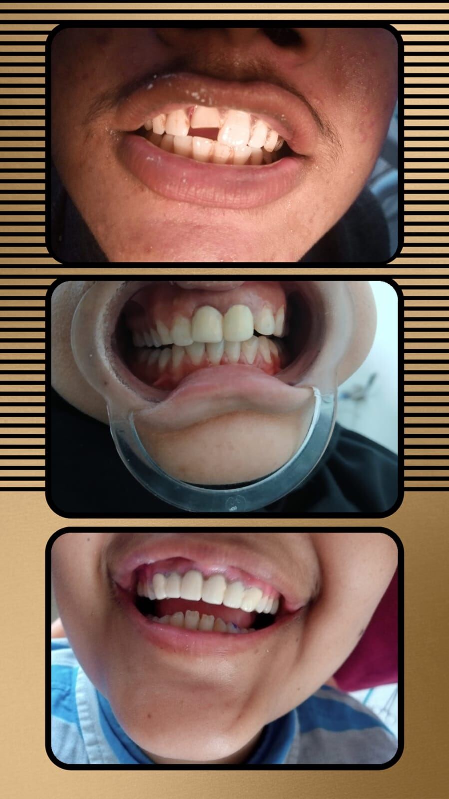 Full Mouth Restoration after